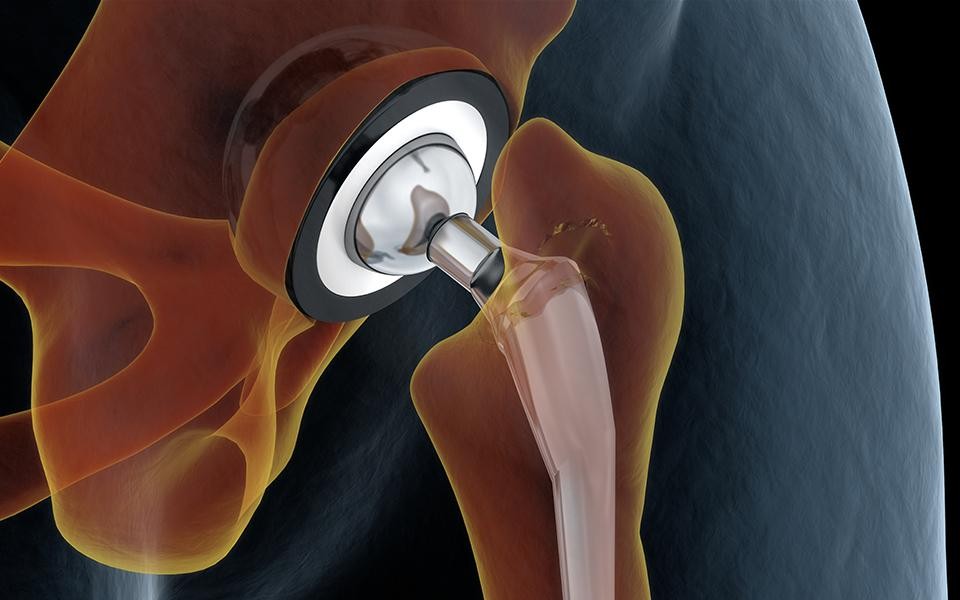 Joint Replacement Centre